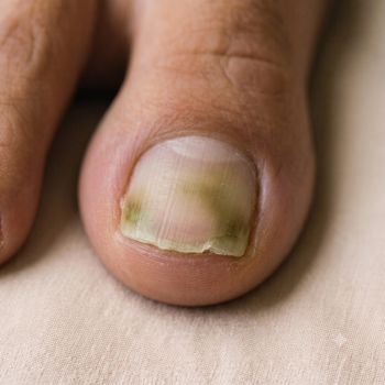 Unhas Esverdeadas