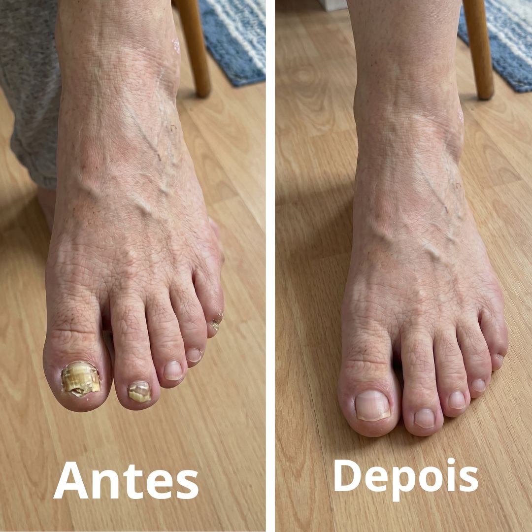 Antes e depois do tratamento com Blend Fungicida