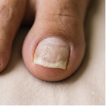 Unhas Grossas